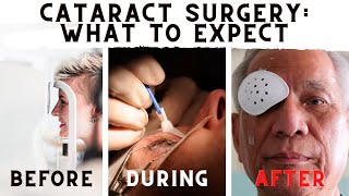 What To Expect Before During And After Cataract Surgery [upl. by Annaegroeg248]