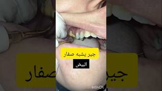 ازالة جير الاسنان dentist stitch اكسبلور stitchlover satisfying [upl. by Liagaba265]