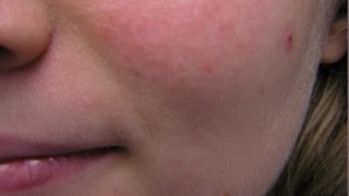 Rosacea  What causes it [upl. by Asusej]