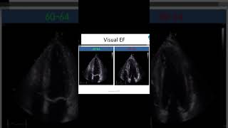 EF 29 or less severe EF visual EF eyeball estimation ejection fraction echocardiography [upl. by Meakem]