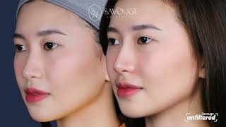 Hiko Nose Lift in just 15 minutes NO SURGERY NEEDED  Ep 4 Picture Perfect for Gen Z Savvies [upl. by Malek]