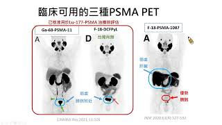 Appropriate use criteria for PSMA PET黃玉儀醫師 [upl. by Belayneh796]