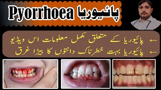 what is PYORRHEA پائیوریا treatment of pyorrhea symptoms information dentalissues treatment [upl. by Gneh]