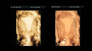 ultrasonography of the myometrium [upl. by Eedrahc]