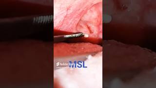 Tonsil Stone Removal [upl. by Magdaia]