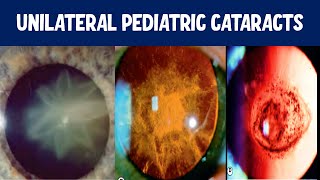 What causes childhood cataracts [upl. by Inilahs]