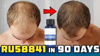 RU58841 Solo 90 Day Results  Newbie Explanation Of Topical AntiAndrogens For Hair Loss Prevention [upl. by Gnud]