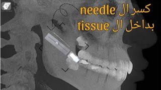 كسر ال needle بداخل ال tissue أثناء الحقن [upl. by Anialam]