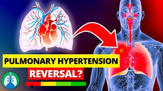 Do THIS to Reverse Pulmonary Hypertension with Natural Methods [upl. by Odnalo]