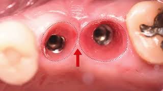 Emergence Profile Temporary Abutment [upl. by Mathis]