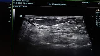 Fibrocystic Breast Disease Sonography [upl. by Eidac]