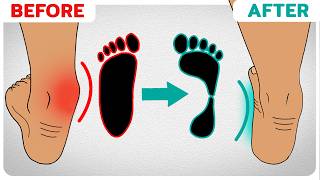 How to Correct Overpronation Fallen Arches [upl. by Leva]