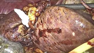 Central hepatectomy HCC [upl. by Annoit]