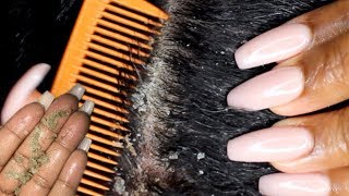 Scalp scratching and picking  Satisfying Dandruff Removal ASMR  Psoriasis [upl. by Esiralc324]