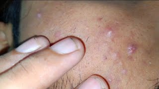 sac be spa blackheads today 2024  sac be spa old age blackheads 2024  sac be spa face information [upl. by Hennie]