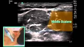 상지 마취를 위한 Ultrasound Guided Interscalene Brachial Plexus Block [upl. by Gaw250]