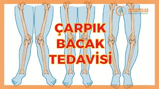 ÇARPIK BACAK SORUNLARI VE ÇARPIK BACAK TEDAVİLERİ [upl. by Rennold]