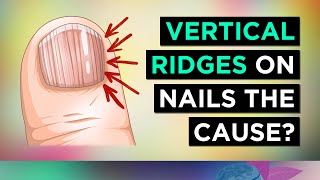 The REAL Causes of VERTICAL RIDGES On Your Nails [upl. by Hightower]