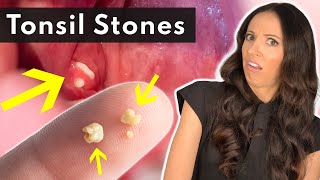 What Are Tonsil Stones amp How To SAFELY Remove Them [upl. by Goodden636]