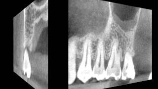 CBCT scan of resorptive defect in an upper molar [upl. by Whitelaw971]