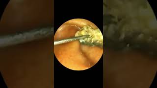 Ear Wax Remains Liquid and Difficult to Clean [upl. by Notlehs]