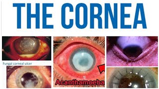 Cornea 6 Major TopicAcanthamoeba Keratitis [upl. by Kegan792]