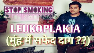 Leukoplakia Causes Symptoms Management amp Treatment  मुंह में सफेद और लाल दाग़ होना [upl. by Atilahs704]