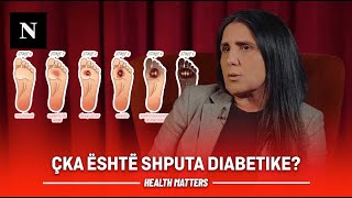 Çka është shputa diabetike 15 për qind e pacientëve me diabet duhet të amputojnë këmbën [upl. by Binetta]