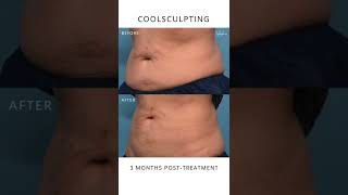 CoolSculpting Results Before and after 3 months [upl. by Anahpos]