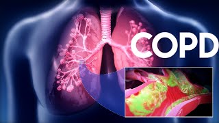 Chronic Obstructive Pulmonary Disease COPDUnit5Pulmonary NursingAHNII Bsn 4rth [upl. by Amador]