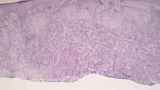 Squamous Cell Carcinoma Moderately Differentiated [upl. by Anidan]