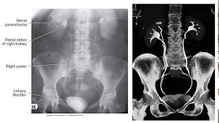 Radiographic Contrast Studies of the Urinary System [upl. by Onivag]