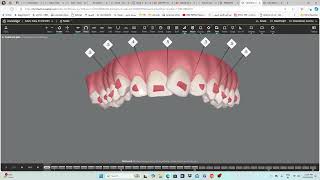 Invisalign  step by step guide [upl. by Zsazsa]