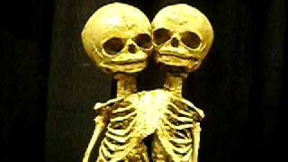 Fetal Oddity Collection  Conjoined Twin  Skeletoncom [upl. by Rives]