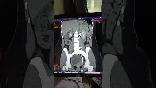 Ct Urographycectge healthcare [upl. by Scrogan919]