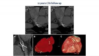 Coronary Sinus Reducer [upl. by Akemrej]