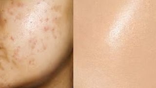 Remove Acne Marks  3 Step  Natural Remedies for Pimple Marks   Prachi SuperWowStyle [upl. by Ecirad]