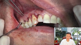 27 Camlog live Tunnel Technique Utilizing NovoMatrix 11092021 Andreas van Orten DDS MSc MSc [upl. by Hsenid]