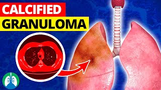 What is a Calcified Granuloma in the Lungs [upl. by Enilrek]