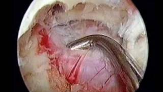 Endoscopic Lumbar Discectomy [upl. by Ahseital]