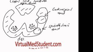 Central Cord Syndrome [upl. by Novyart]