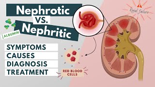 Nephrotic vs Nephritic syndrome  Symptoms diagnosis causes treatment  Visual explanation [upl. by Hairem825]