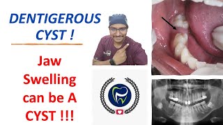 Dr Rudra Mohan  Dentigerous Cyst Swelling of the Jaw Could be A CYST [upl. by Nylrats131]