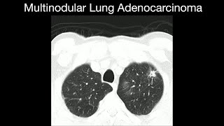 Multinodular Lung Adenocarcinoma [upl. by Tobey]