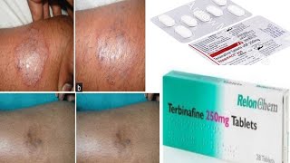 Terbinafine tablet uses and side effects full review [upl. by Saunders42]