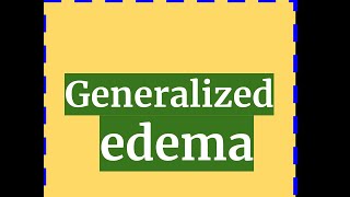 GENERALIZED EDEMA [upl. by Goldman]