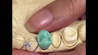 upper premolar waxup [upl. by Gwyneth]