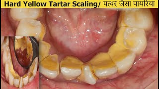 Dental CleaningScaling of Tartar  Irregular teeth  More Chances of Tartar Deposits Dr Ram MDS [upl. by Alyakcim]