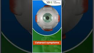 Cataract Symptoms  Cataract  SBH Hospital  Raipur  Chhattisgarh [upl. by Hsirap]