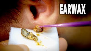 THE BEST EARWAX REMOVAL EVER and most gross  Dr Paul [upl. by Tera]